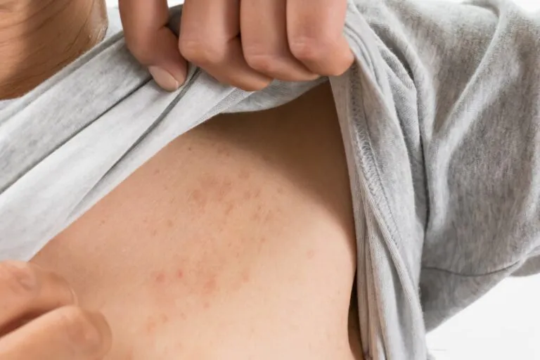 辻堂であせもの治療ならいわもと皮フ科クリニック