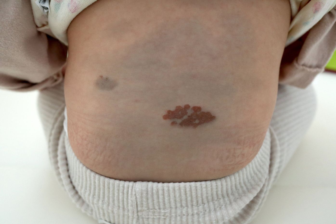 生まれたときから背中に色の濃いあざが２つ。「自然には消えない」と言われ、レーザー治療を決意 異所性蒙古斑・体験談 たまひよ