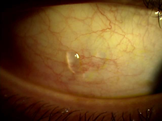 感染性角結膜炎 はやり目等- 静岡県島田市の眼科 おおるり眼科クリニック