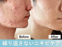 フェイシャルエステメニュー静岡市のメンズ脱毛サロン KIBIK キビック 話題のメンズ脱毛もお得なプランでご提供