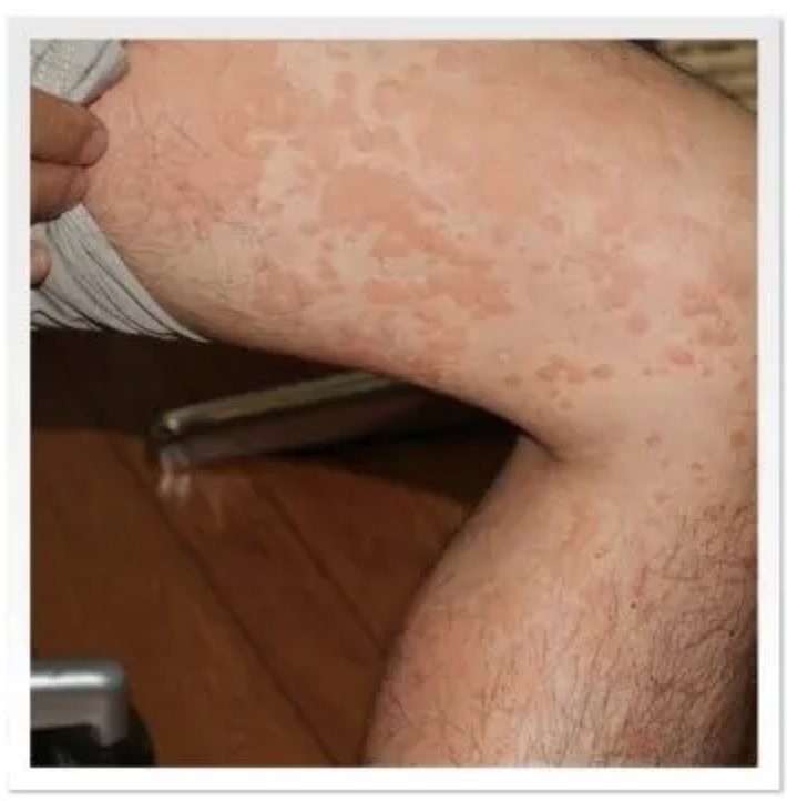 ジアノッティ症候群 - 茨木市の小児科－はら小児科クリニック