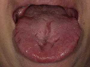 下顎智歯と下顎枝の位置関係やましろ歯科口腔外科口腔外科・口腔内科福岡で親知らずの抜歯、ドライマウス、睡眠時無呼吸症候群、口腔がん健診のことならやましろ歯科口腔外科へ。日本口腔外科学会認定専門医が治療します。下顎智歯と下顎枝の位置関係