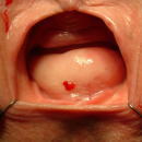 骨盤臓器脱 子宮脱・膀胱瘤・直腸瘤 とは