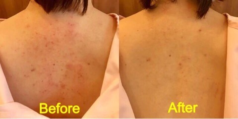 乾燥する季節、おさまらない背中のかゆみに 眠りの妨げにも 皮膚科医が解説！かゆみを止める対策ヨガジャーナルオンライン