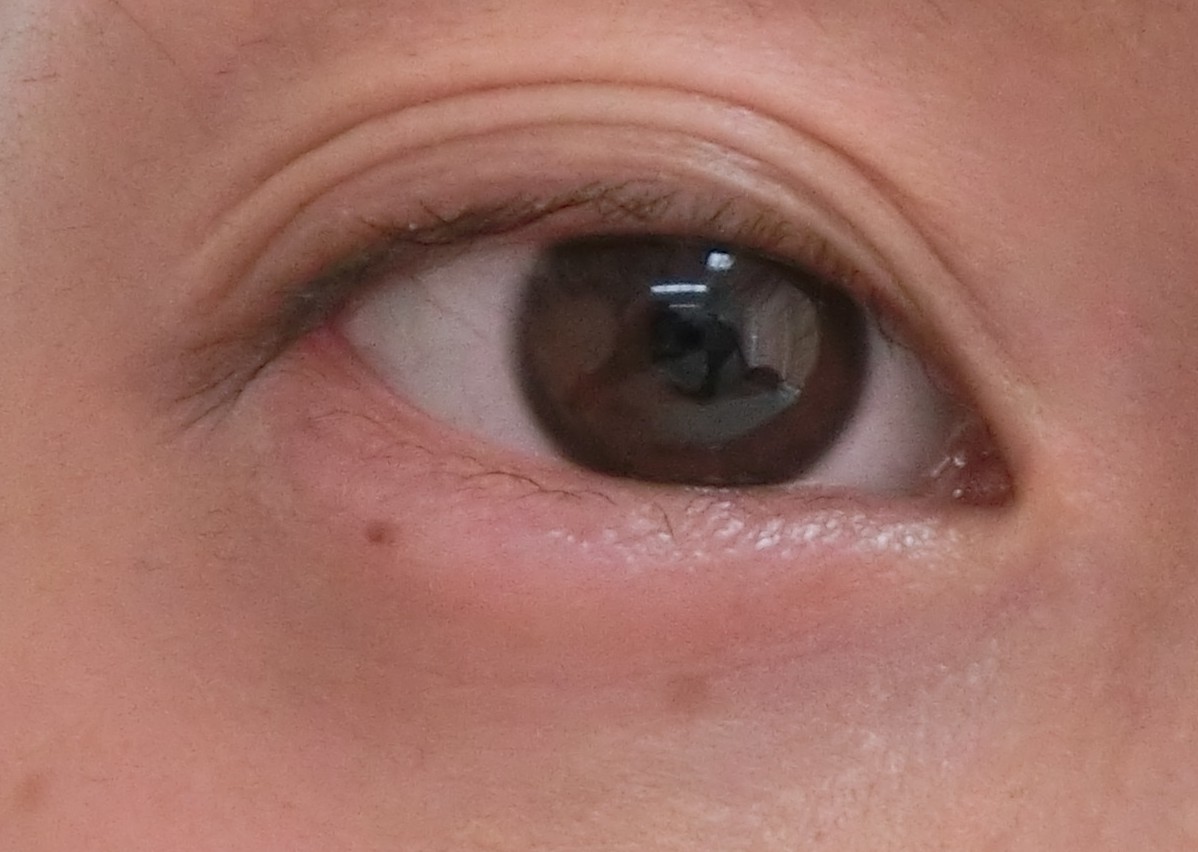 三重まぶたは遺伝？生まれつき？赤ちゃんからまぶたはどう変わる