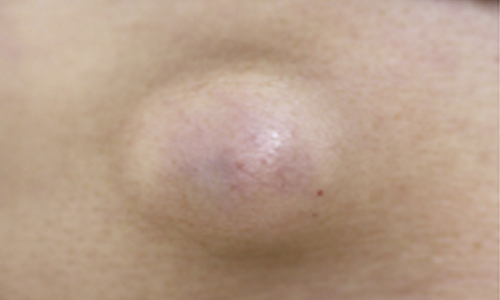 できもの 良性腫瘍すがも小林皮フ科