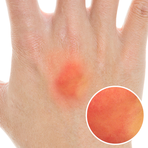 えぬくりブログ: 皮膚がん