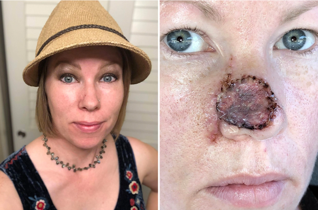 鼻ニキビの原因と治し方を解説鼻ニキビに有効な処方薬も紹介ANS. magazine