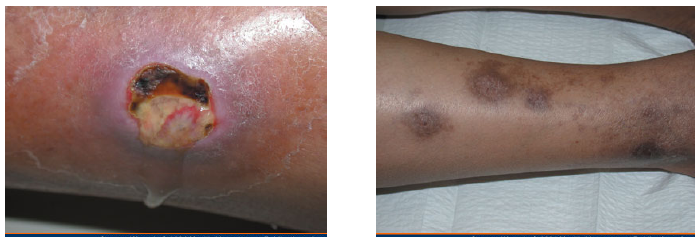 糖尿病の人は「帯状疱疹」を発症しやすい 50歳以上は要注意日刊ゲンダイDIGITAL