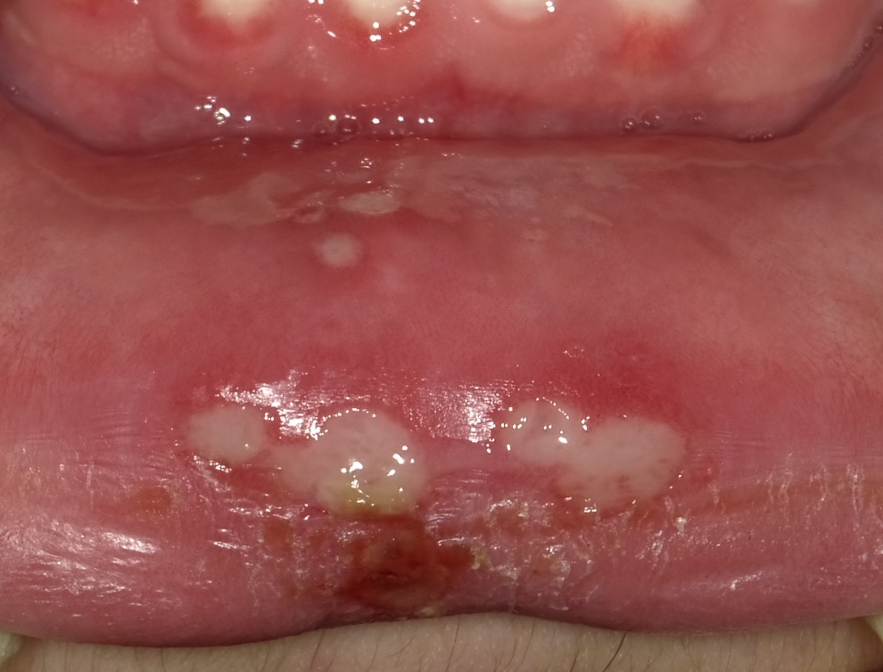 口腔扁平苔癬歯科口腔外科症例解説東京銀座シンタニ歯科口腔外科クリニック
