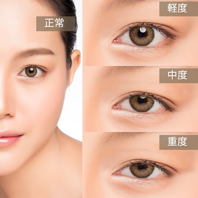 ぱっりちデカ目は無敵！お疲れ顔と眼瞼下垂を予防する「眼輪筋エクサ」美的.com