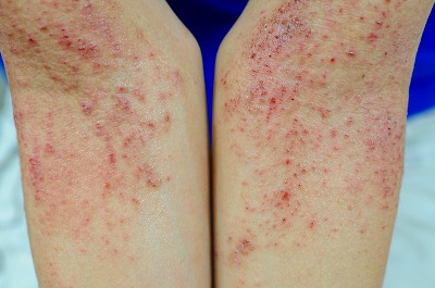 自分の腕にじんましんが💦疲れると夜出ることがあるのですが、きれいに線状 に赤くなっていてまさに教科書的に有名な皮膚描記😨抗ヒスタミン薬のデザレックスを飲んだら1時間くらいでひきました💊じんましんやアレルギー性鼻炎には眠気が少なくいつでも飲めるデザレックス