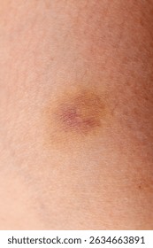 あざの種類と原因神戸市東灘区の甲南山手まゆみ皮フ科