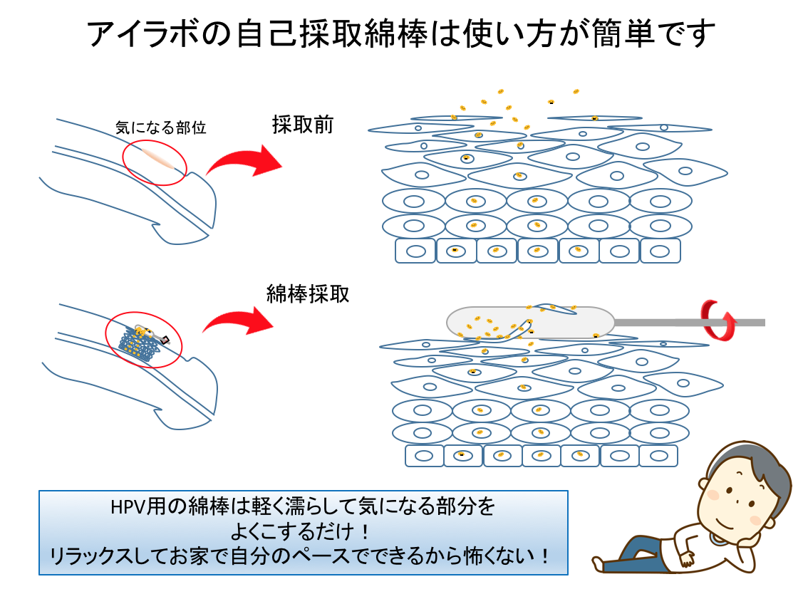 尖圭コンジローマセルフチェック 男性- イボイボ コミュニケーション スタジオ