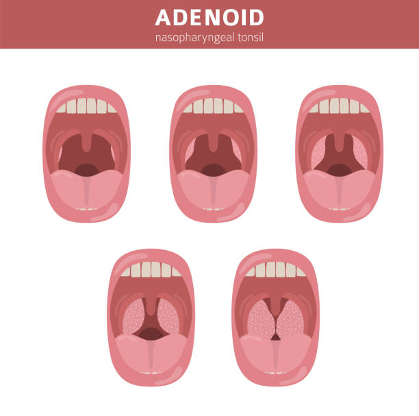 小児 急性扁桃炎・咽頭炎どい耳鼻咽喉科 船橋日大駅前院