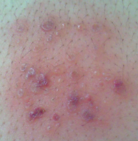 眼部帯状疱疹とは - 医療総合QLife