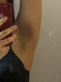 脇の黒ずみケア方法と美白効果を実感！TikTok