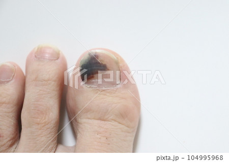 爪内出血が出ていかない！！ - 巻き爪補正・フットケア専門店 HISHO