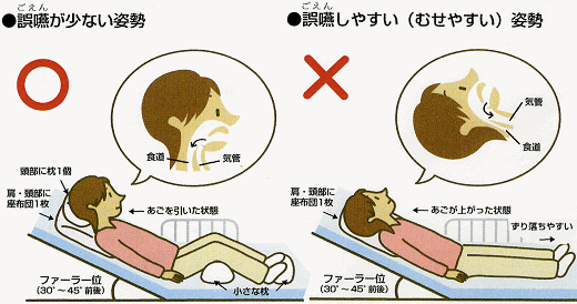 ベッド上ポジショニング誤嚥を防ぐポジショニングと食事ケアの技術伝承