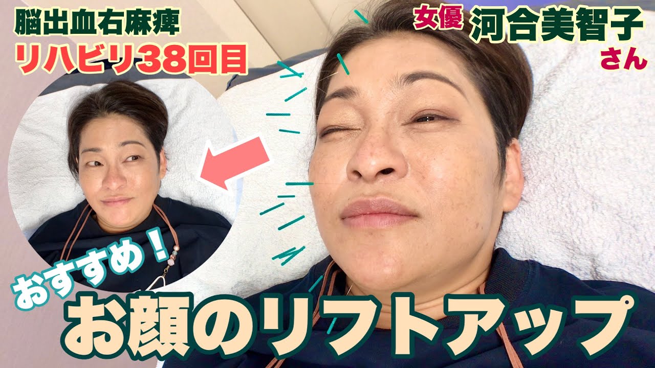 脳卒中後遺症 顔が思うように動かない！顔面神経マヒって何？ - 脳梗塞Labo マヒリハ