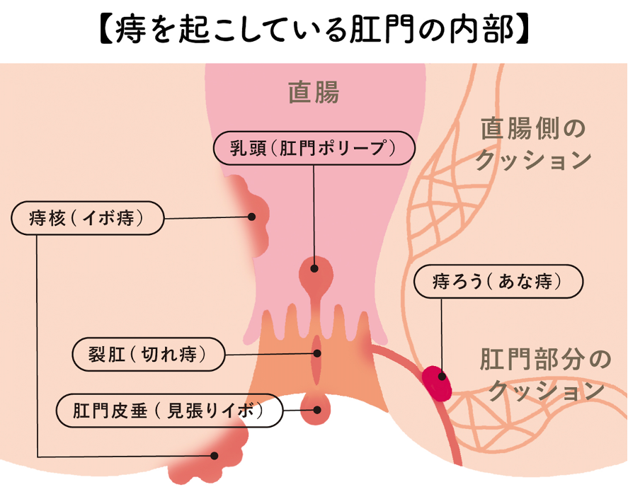 おしりやその奥の方 直腸 辺りが痛い。病院に行ったけど何もないと言われた。 機能性直腸肛門痛_慢性骨盤痛 高野病院