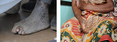 日本財団ハンセン病フォトギャラリー日本財団