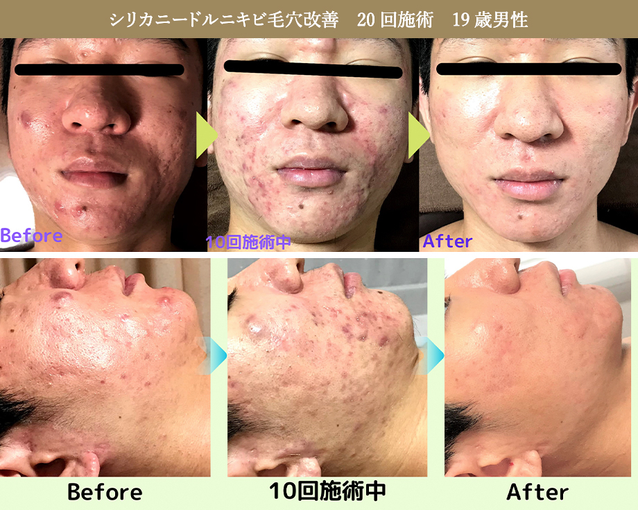 毛穴ケア男のためのエステサロン明石・加古川のメンズ脱毛 フェイシャルエステひかり素肌