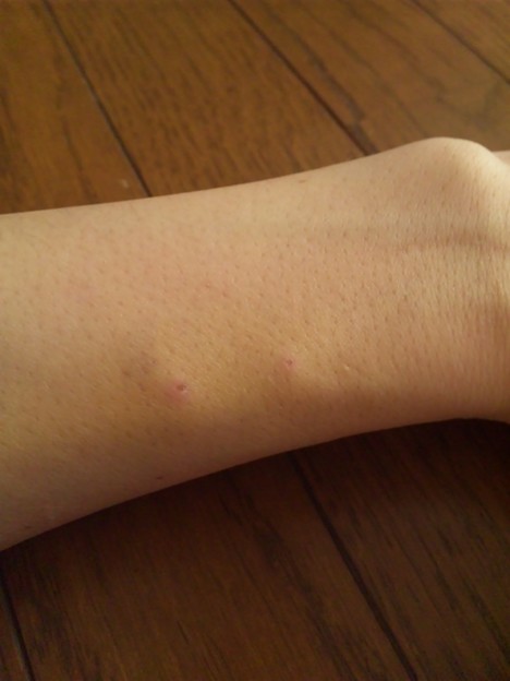 点滴後に内出血した子供の手の甲 - No: 2621344写真素材なら「写真AC」無料 フリー ダウンロードOK