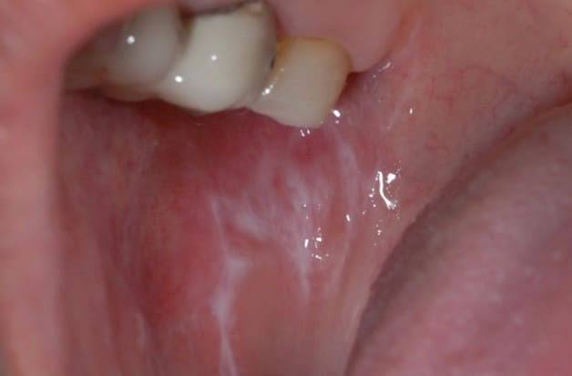 カンジダ症 腟カンジダ はうつる？原因と症状、治療法 公式 新宿駅前婦人科クリニック