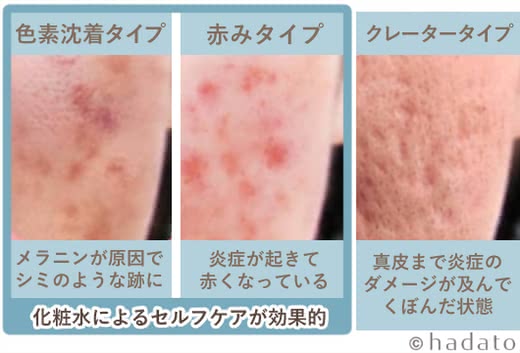 ニキビ対策で、頬のニキビ跡の赤みが気にならないように。 - ニキビケアは根本対策のこことみグループ cocotomi