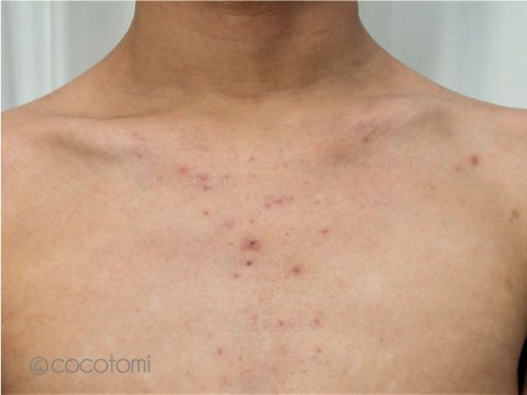 ニキビ 赤み、でこぼこ ・酒さ一般皮膚科 症状別の病名一覧渋谷スクランブル皮膚科渋谷駅徒歩1分