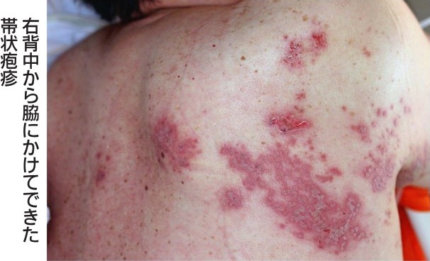 帯状疱疹でお悩みですか？ 帯状疱疹は、神経に沿ってピリピリと刺すような痛みと、赤い斑点と小さな水ぶくれが帯状にあらわれる病気で季節の変わり目や体が疲れている時に発病しやすくなります。通常であれば2週間ほどでかさぶたになり痛みも引きますが、症状が重い場合