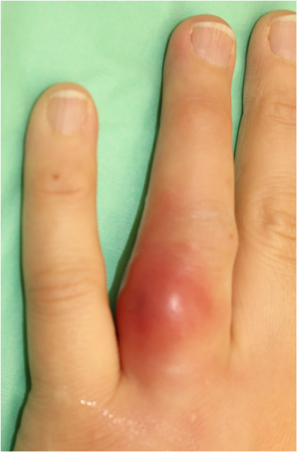 切開排膿について〜不要不急でない状態〜 – 医療法人 双英会 YUKI皮フ科形成外科一宮市時之島の皮膚科、形成外科