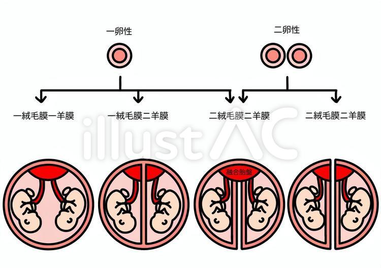 一絨毛膜一羊膜の双子。リスクと対策は？ 匿名希望様岩城産婦人科妊活ブログ