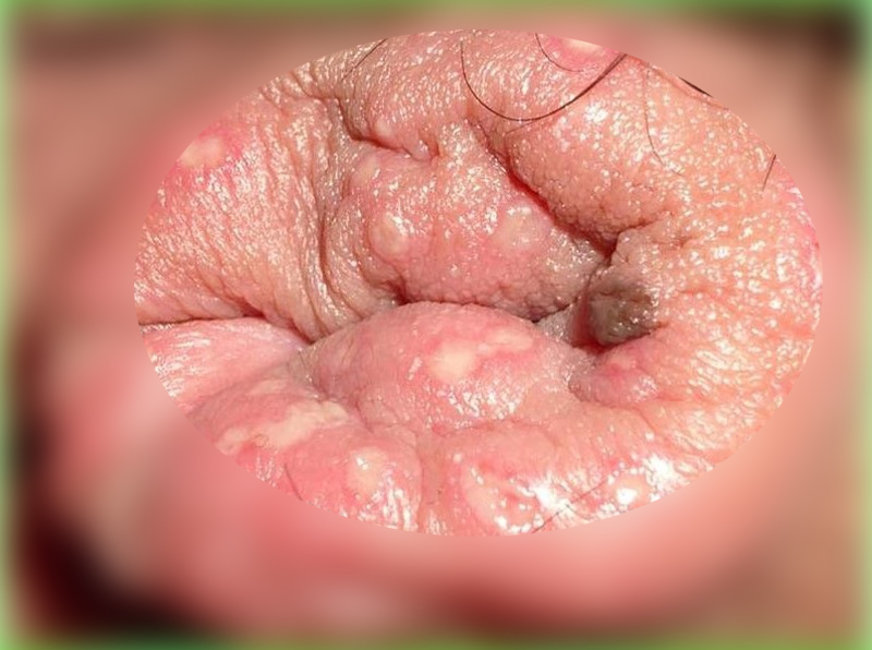 医師監修・作成 口唇ヘルペスの症状：ピリピリ、痛み、水ぶくれ、かさぶたなどMEDLEY メドレー