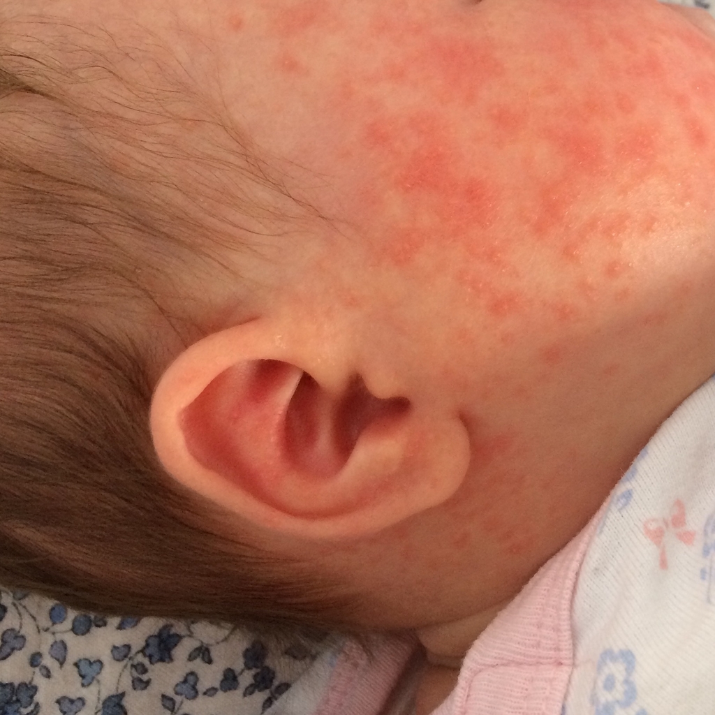 新生児ざ瘡 - Wikipedia