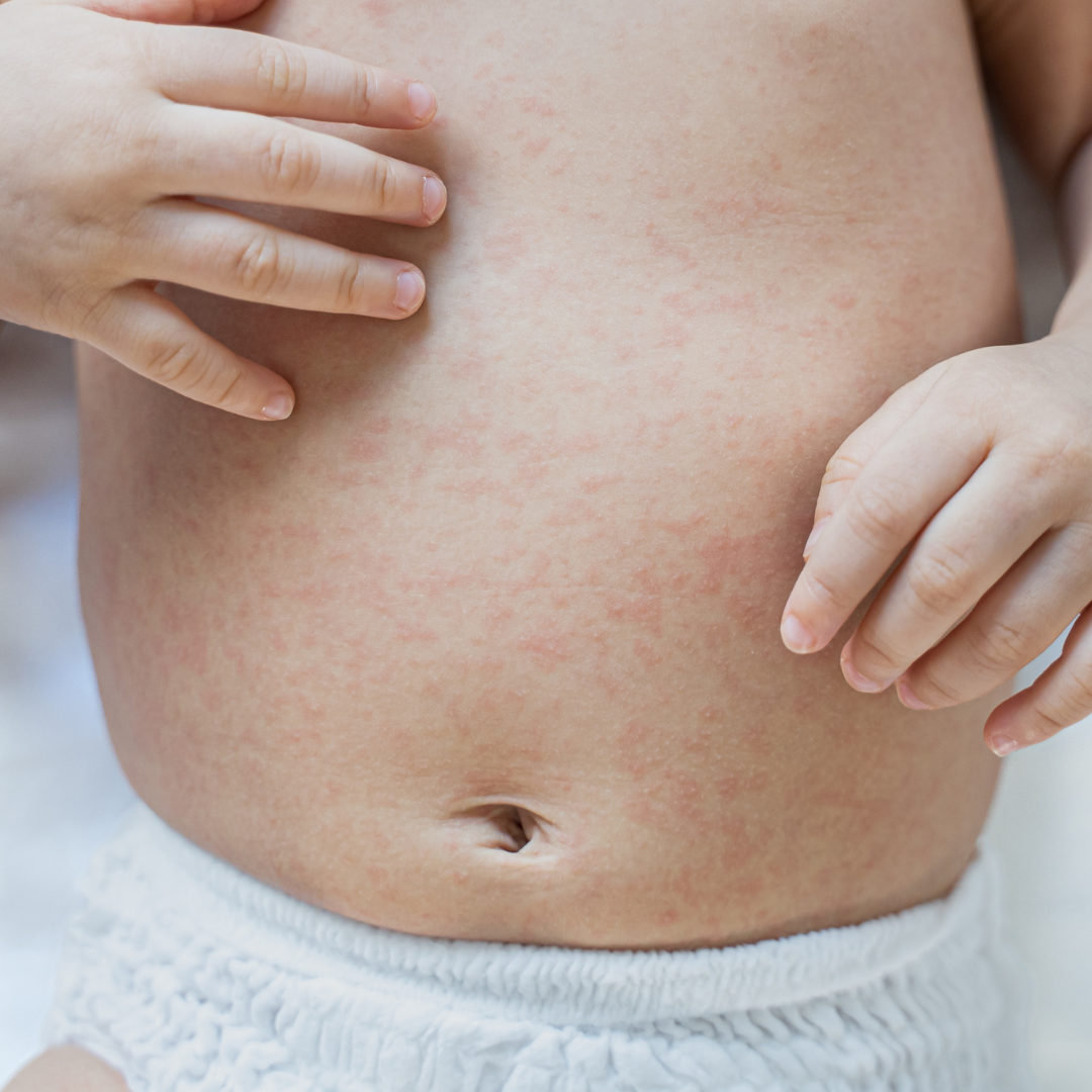 赤ちゃん・子どもの『あせも』対策と予防法田辺三菱製薬ヒフノコトサイト