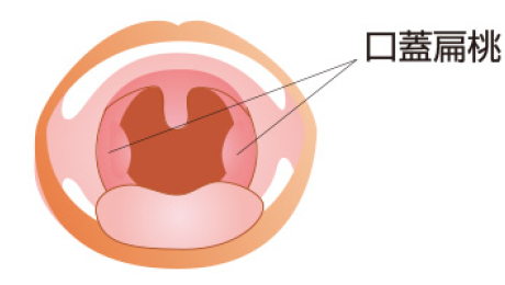 扁桃肥大、アデノイド増殖症いちはら耳鼻咽喉科クリニック佐賀市の耳鼻咽喉科