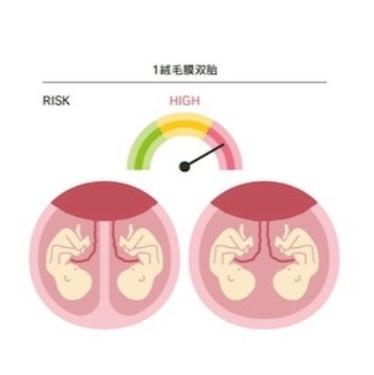子宮の中の双子の赤ちゃん イラスト入り図解 のイラスト素材41951155- PIXTA