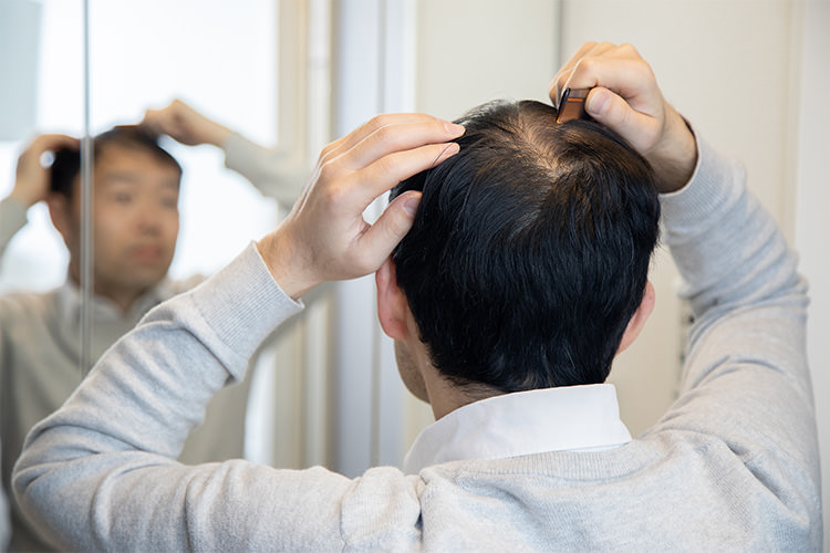 危険 頭皮のニキビは薄毛の前兆？治療すべき”できもの”5選も紹介 - 自毛植毛アルモ形成クリニック東京秋葉原