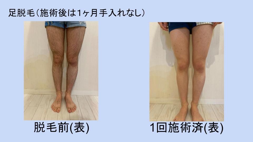 男性の医療脱毛で効果が出る期間や回数は？プライベートクリニック恵比寿美容外科・美容皮膚科・ダイエット