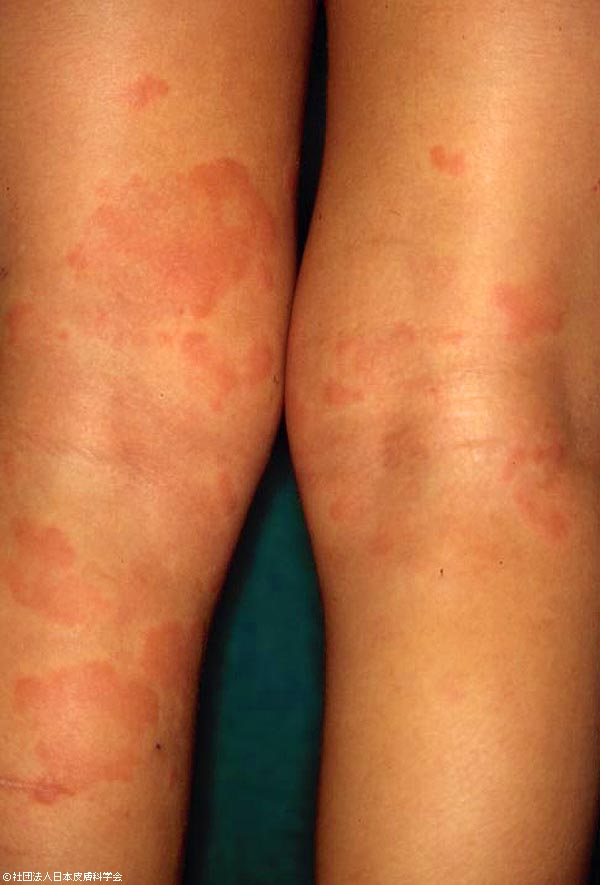 皮膚画像検索 │ ひふ研 「ひふ症状、ひふ薬の使い方の疑問に答える情報サイト」 │ 第一三共ヘルスケア