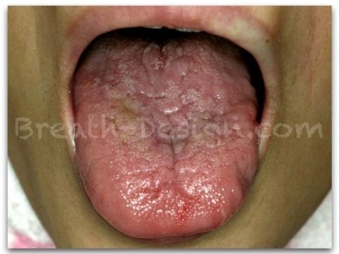 口臭を引き起こしやすい地図状舌と溝状舌について大阪口臭センター・ほんだ歯科口臭外来部 Dr.本田のブログ～口臭症治療・ドライマウス・アンチエイジング～