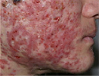 メンズ向け 名古屋でニキビ跡治療が安い男性におすすめのクリニック・皮膚科8選種類別の治療法やクリニックに行くべき人の選び方BeautyPark Clinic