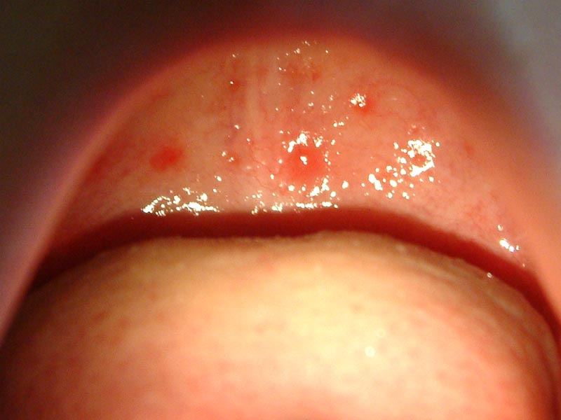 家での感染を防ぎたい！ 夏の手足口病・ヘルパンギーナ・プール熱になったら。看護師ママが教える家庭内の感染対策法HugKum はぐくむ