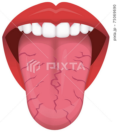 Q.舌にできる、ギザギザした跡は何？ - 新浦安の歯医者・歯科栗林歯科医院各専門医在籍