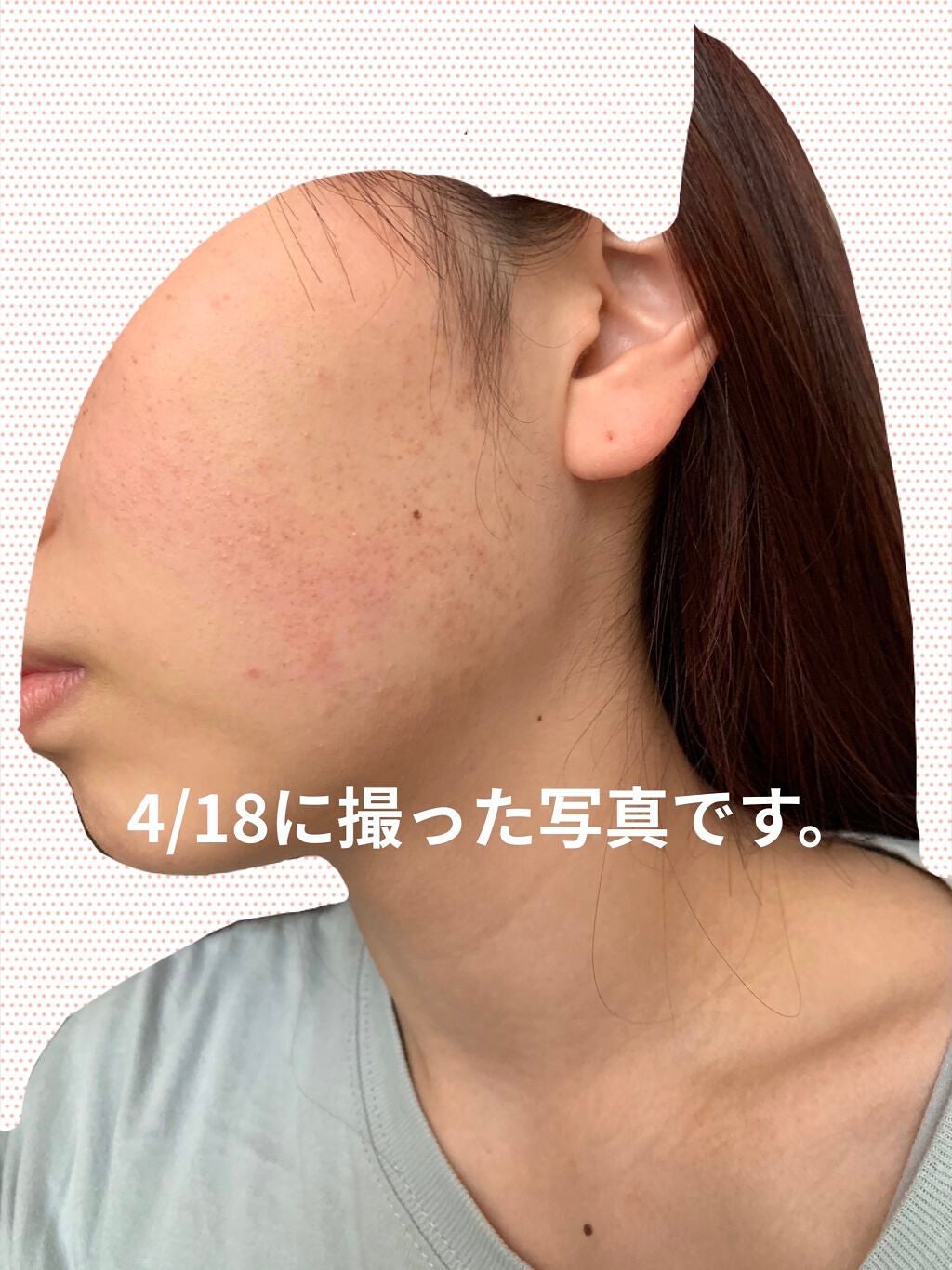 毛孔性苔癬・角化症治療セルフチェクや治療法・注意点のご紹介 公式 オザキクリニック 新宿・目黒祐天寺・羽村