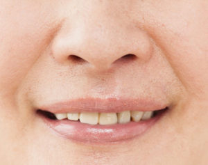 小鼻を小さくする方法や自力で鼻の穴と鼻を整える方法を医師が解説美容整形は東京シンデレラ美容外科 新宿 池袋 大宮