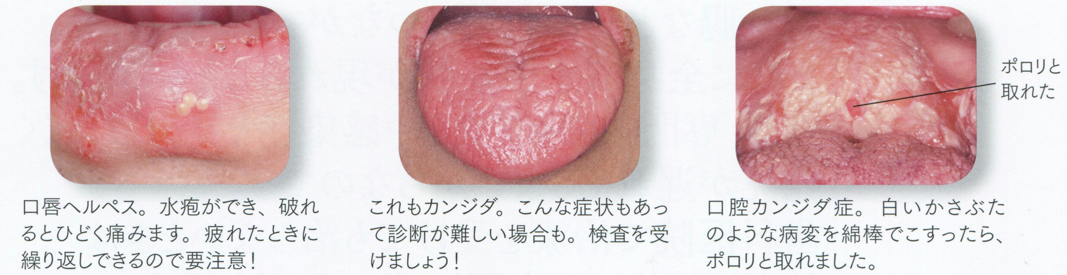 口内炎の診断・治療 - 新谷悟の歯科口腔外科塾