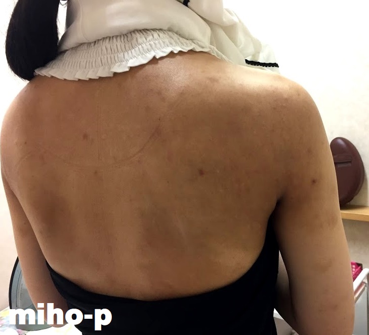 アトピー性皮膚炎の基本情報 Part 1 重症度・検査・診断について - CAI認定機構